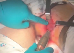 Снаряд длиной 16 сантиметров извлекли врачи луганского военного госпиталя из тела раненого военнослужащего